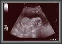 ultrasound1